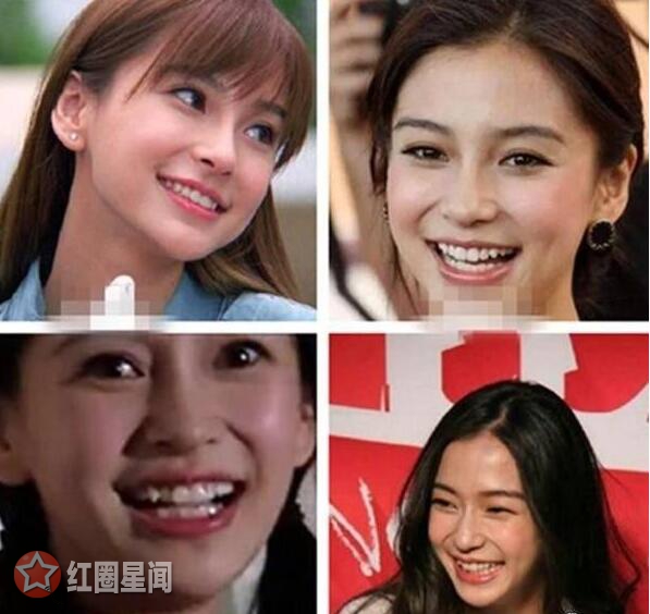 baby牙齿反弹又整牙了 baby小虎牙不见了动手脚了
