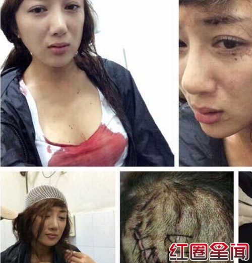 李依晓被狗咬伤