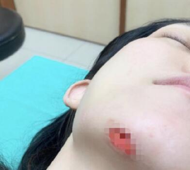 范玮琪下巴缝15针