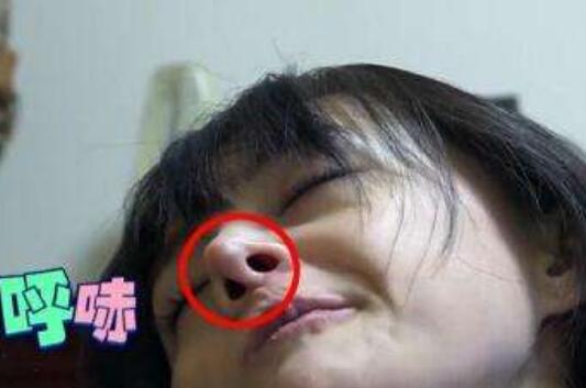 郑爽鼻子怎么了